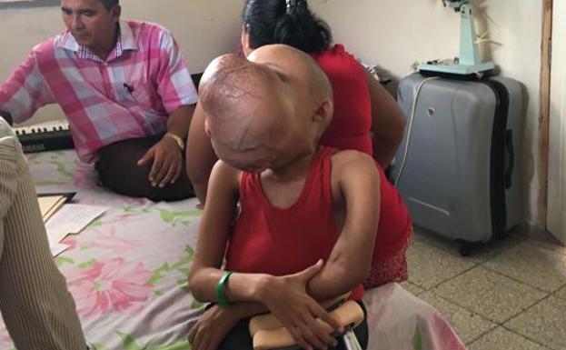 Cirujanos extirparán un tumor facial de 4,5 kilos a un niño cubano en Miami