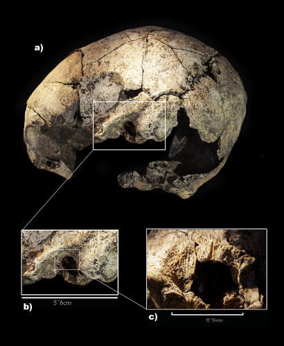 La primera operación de oído de la historia