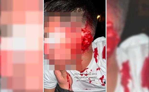 Una oreja y un dedo cortados en una pelea que «nunca existió» en un bar de Valladolid
