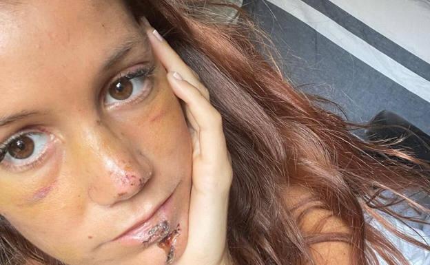 Miri Pérez, de 'Masterchef 5', muestra la evolución de sus heridas tras su accidente de moto