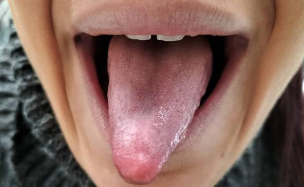 Así es la 'lengua covid', clave para un diagnóstico precoz