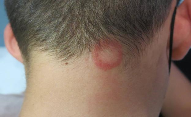 La moda del rasurado de pelo que propaga la tiña