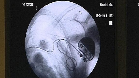 Más protección para marcapasos conectados a internet