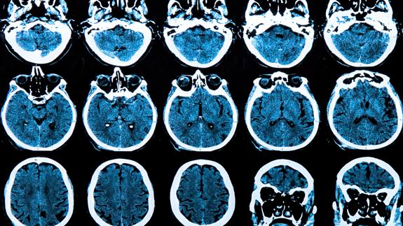 Descubren que el Parkinson puede originarse en el intestino