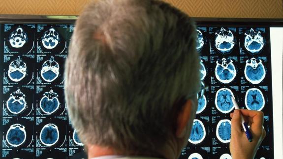 Hallan uno de los mecanismos genéticos implicados en el desarrollo del Alzheimer