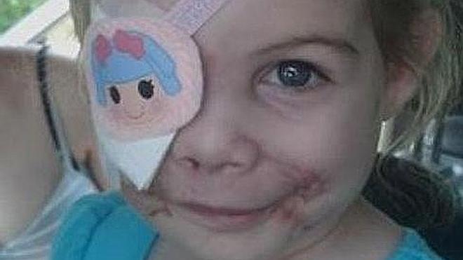 Expulsan a una niña de un restaurante por las cicatrices de su rostro