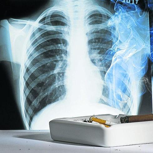 El diagnóstico tardío relega a un 15% los cánceres de pulmón que pueden operarse