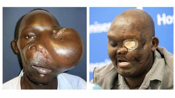Extirpan en Valencia el tumor gigante que había deformado la cara a un keniano